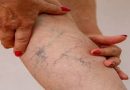 Cold Feet and Heavy Legs Could Be a Sign of Varicose Veins, Says Study